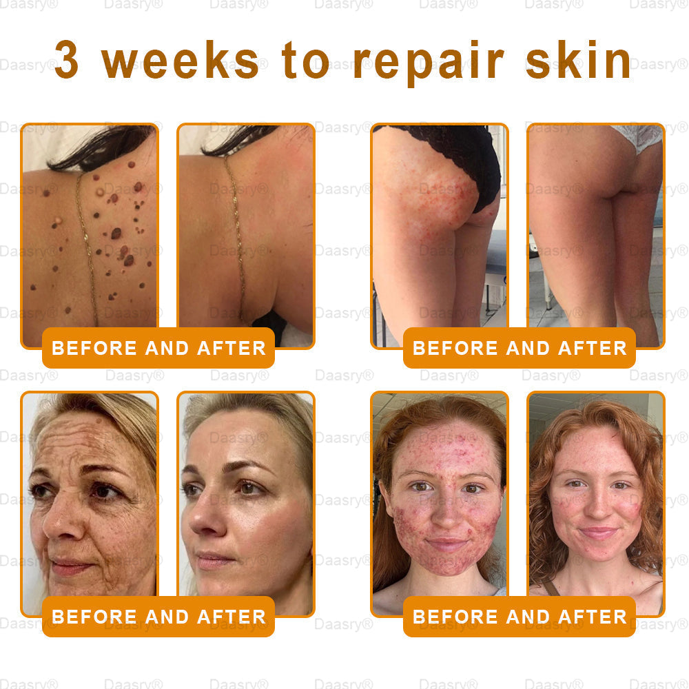 FDA Official: Daasry® Botox Bee Venom Skin Restoration Cream - Anti-aging, Hydrating, Skin Firming & Lifting, Skin Repair, Even Tone, Acne and Dark Spot Treatment, Wart and Mole Removal, and Psoriasis Relief.