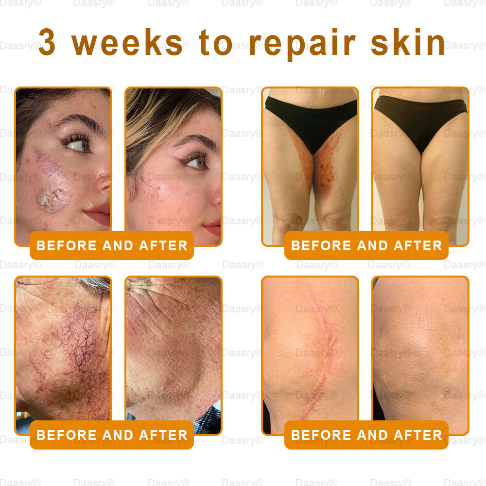 FDA Official: Daasry® Botox Bee Venom Skin Restoration Cream - Anti-aging, Hydrating, Skin Firming & Lifting, Skin Repair, Even Tone, Acne and Dark Spot Treatment, Wart and Mole Removal, and Psoriasis Relief.